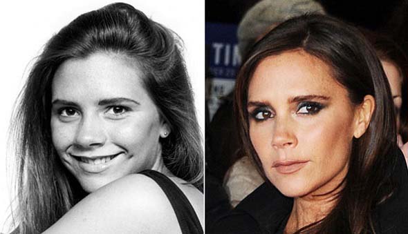 Victoria-Beckham-Plastic-Surgery-Before-After