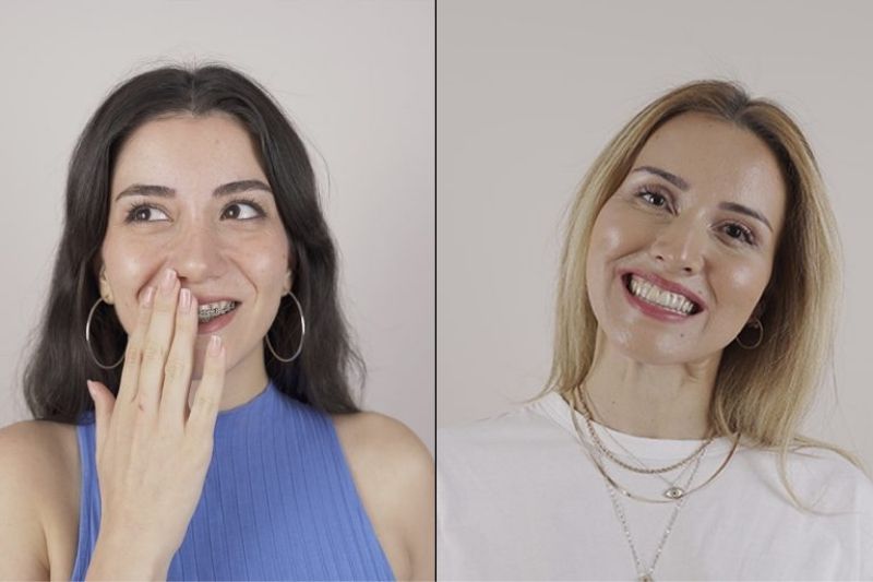 Şeffaf Plaklar ile Daha Estetik Bir Gülümseme