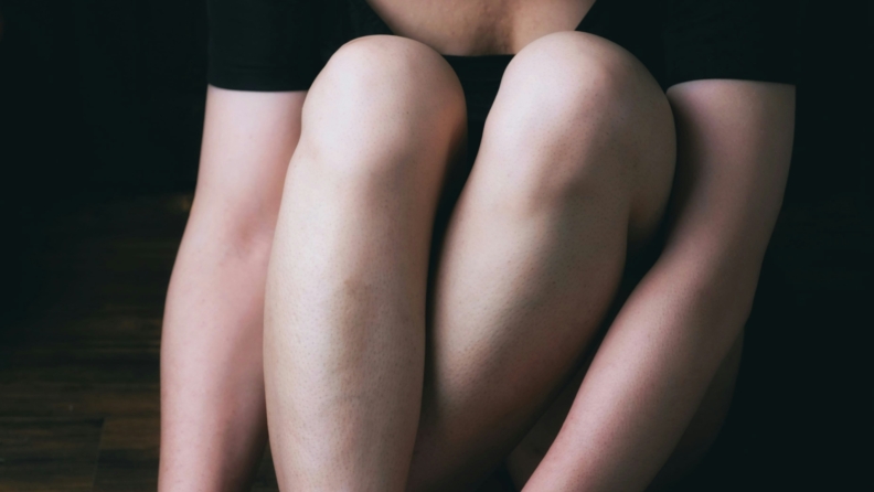 Kozmetik amaçlı varis tedavisinin tam zamanı